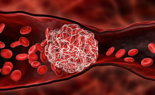 Illustration of blood clots forming in a vein.